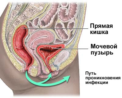 Что вызывает цистит?
